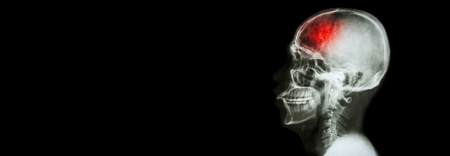 act-f-a-s-t-if-you-think-someone-is-having-a-stroke
