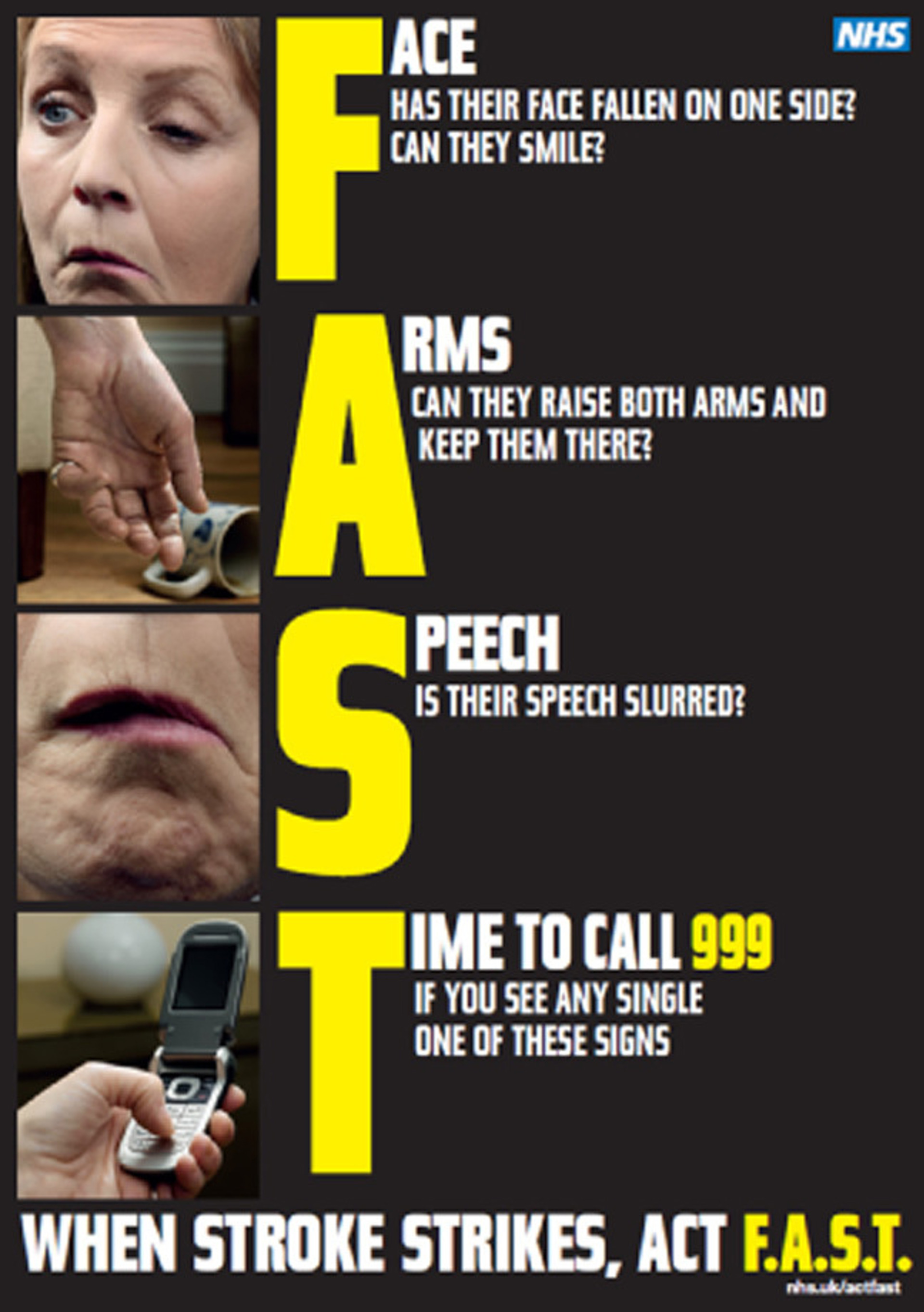 NHS Stroke symptoms
